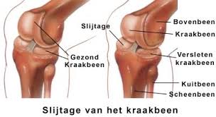 Anatomische tekening van knieslijtage en beschadigd kraakbeen.